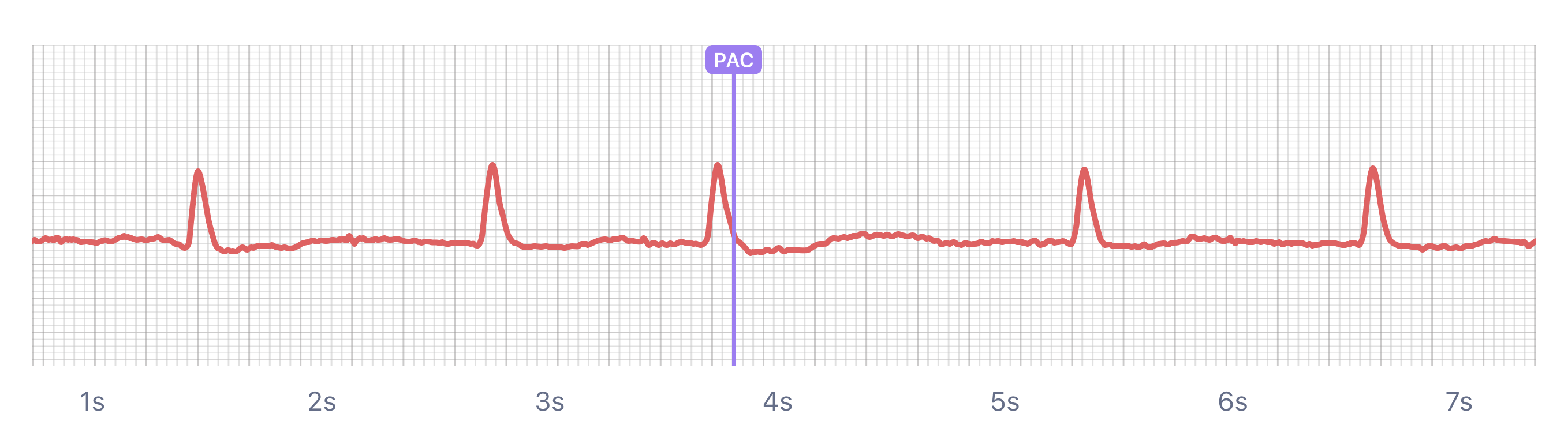 Paced Rhythm on smartwatch ECG (Apple Watch, Kardia, Samsung, Fitbit)