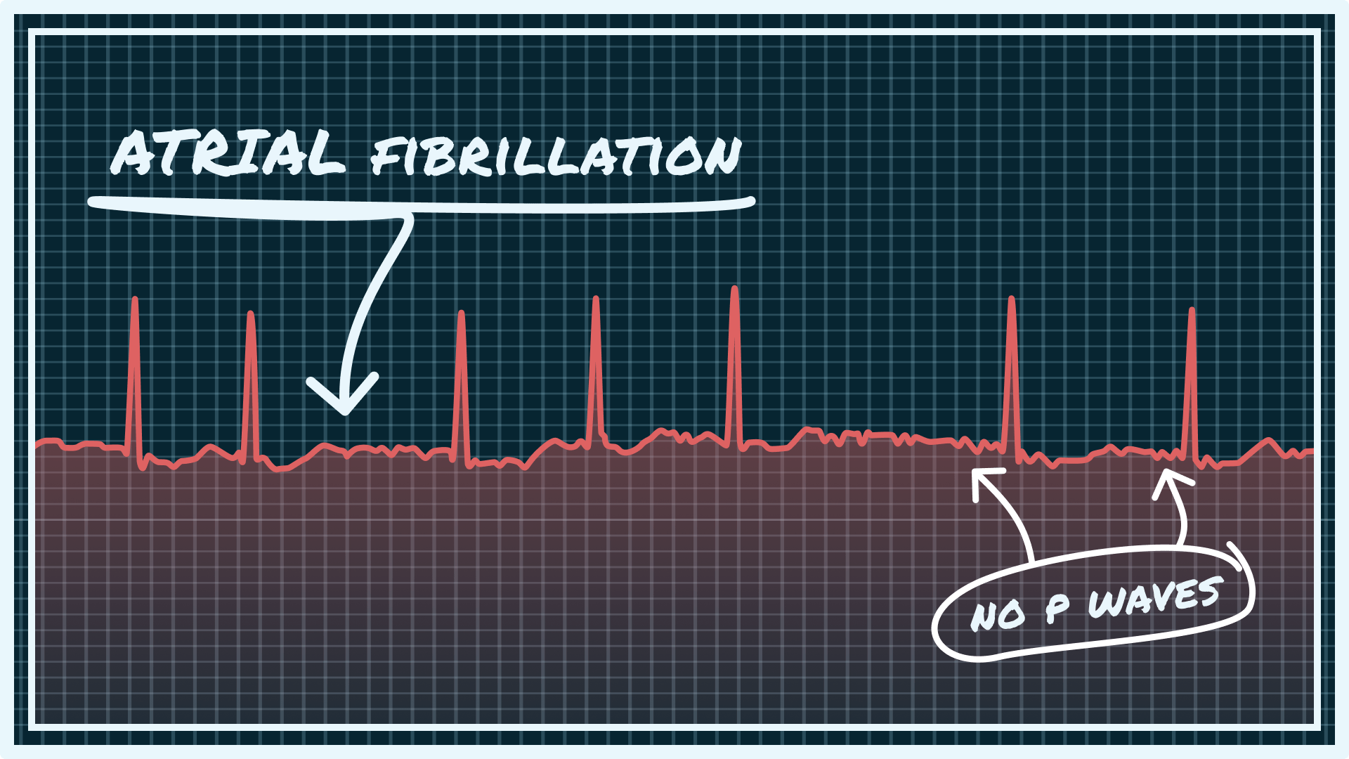 Ventricular Fibrillation Vs Atrial Fibrillation