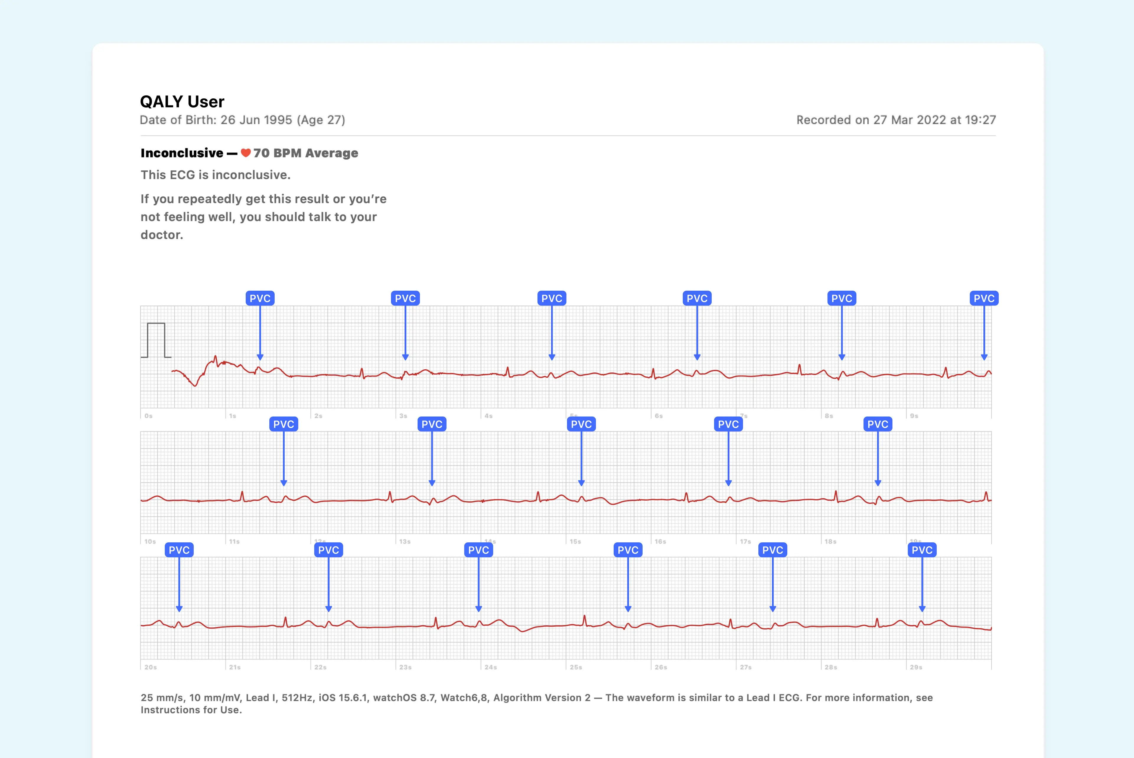 Is Your Heart Skipping Beats? Bigeminy Or Trigeminy? Find Out Now! - ie9m1y6