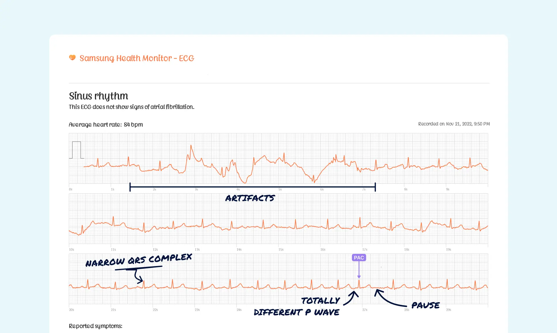 Premature Ventricular Contraction (PVC) Vs. Premature Atrial ...