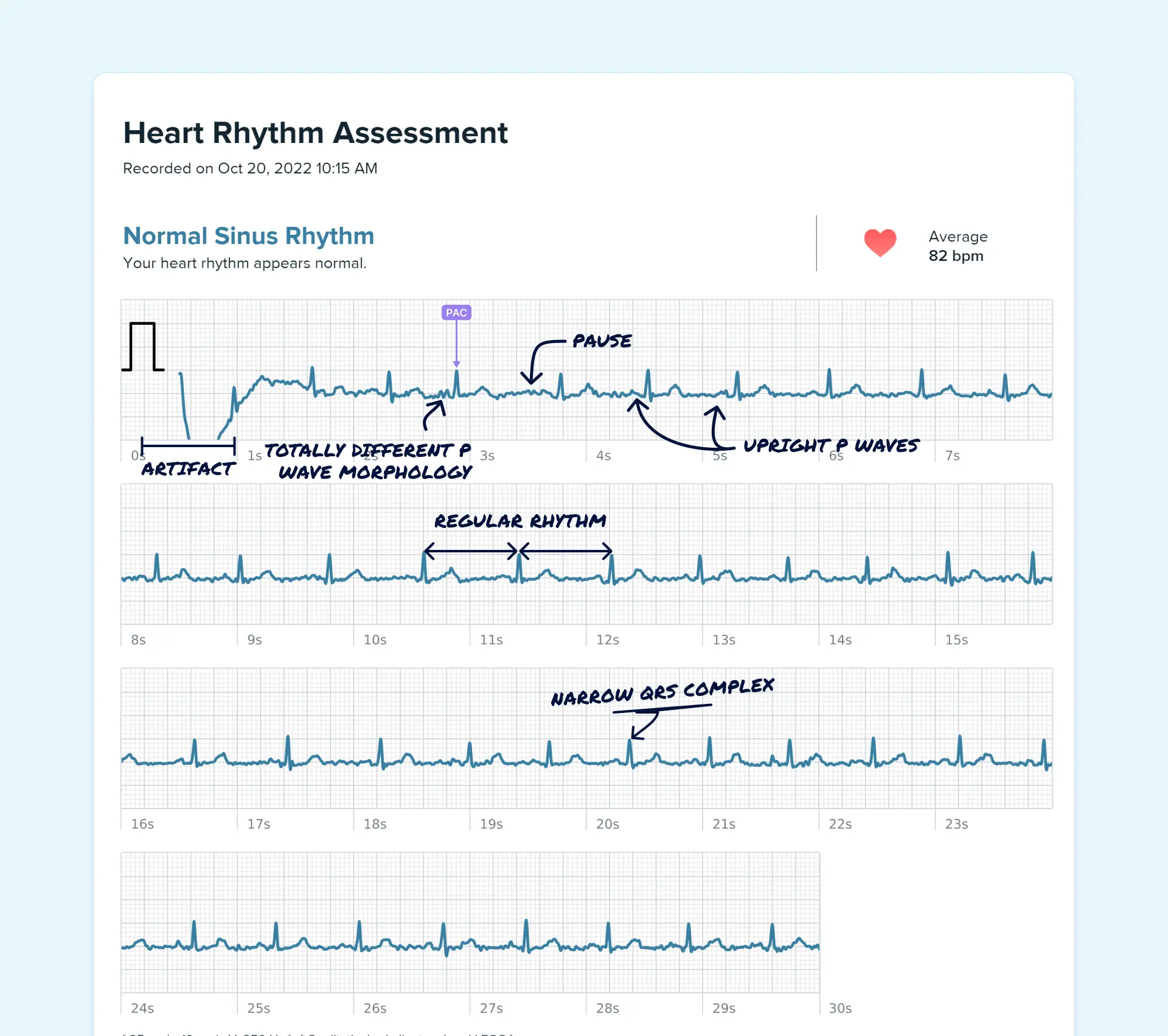 This Simple Test Could Detect Pvc Icd 10 Early - hlq6ku3
