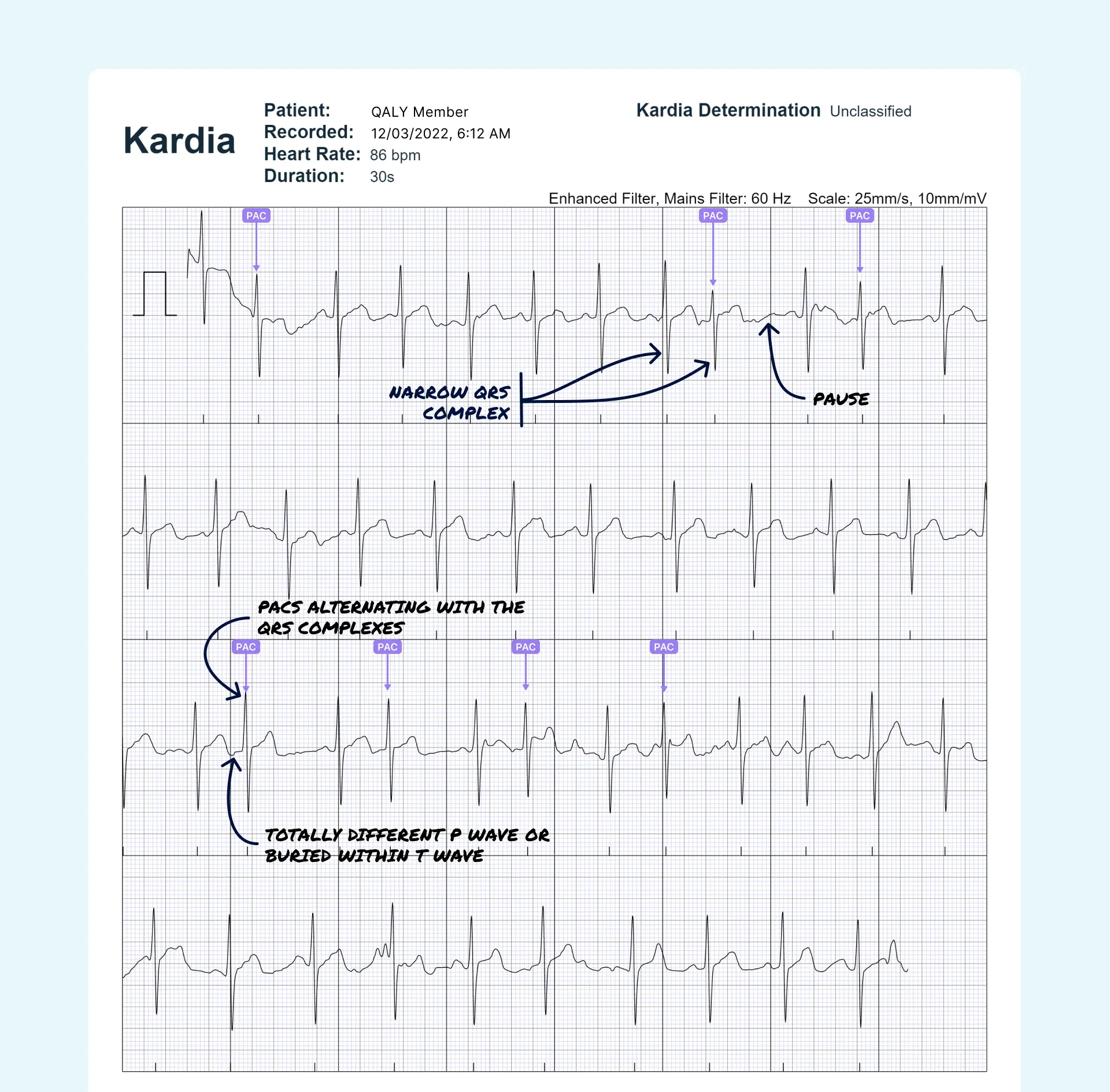 Trigeminy Vs Bigeminy On Ekg Atrial Bigeminy ECG Interpretation With 