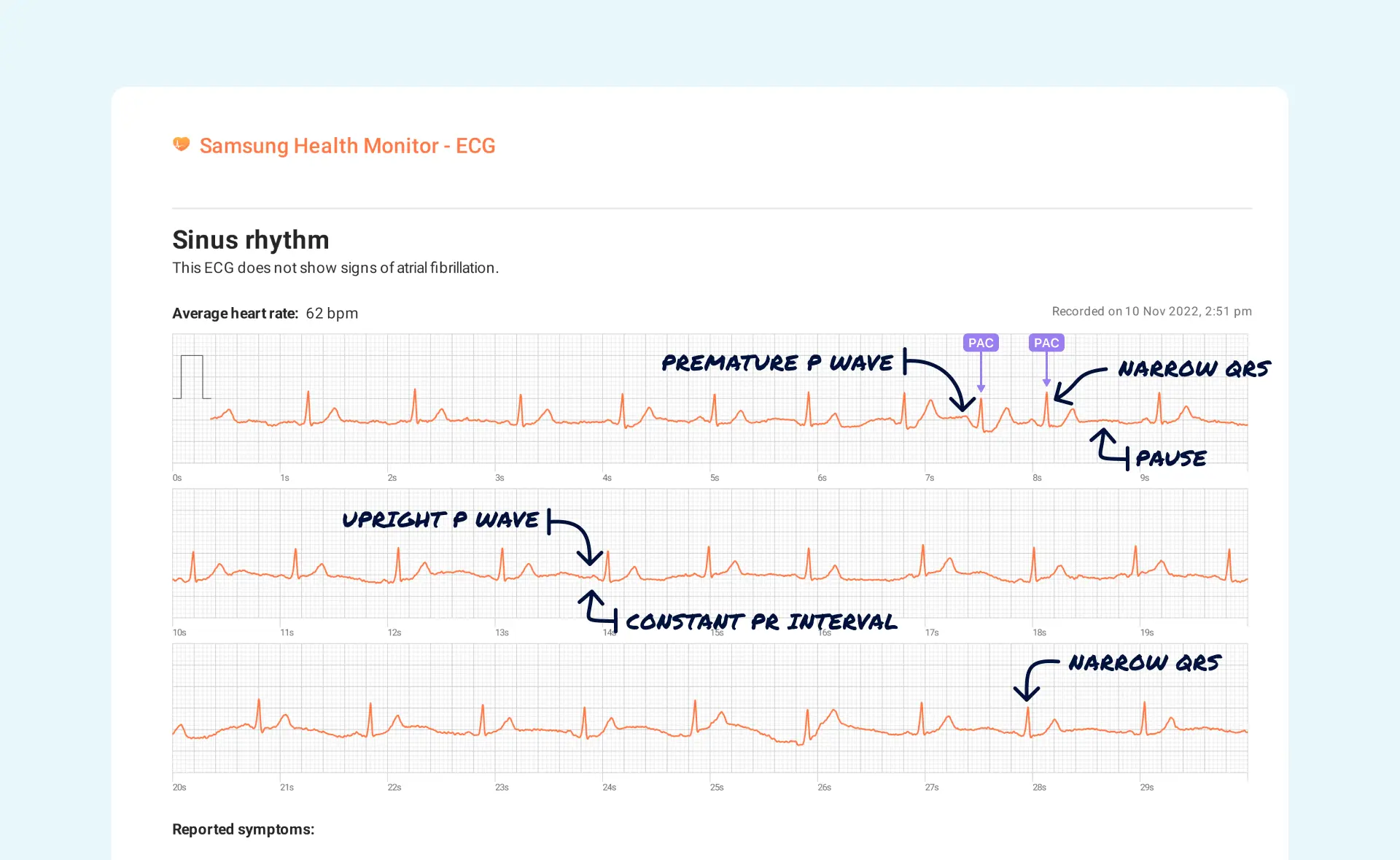 Premature Atrial Contraction (Couplet) Vs. Premature Ventricular ...
