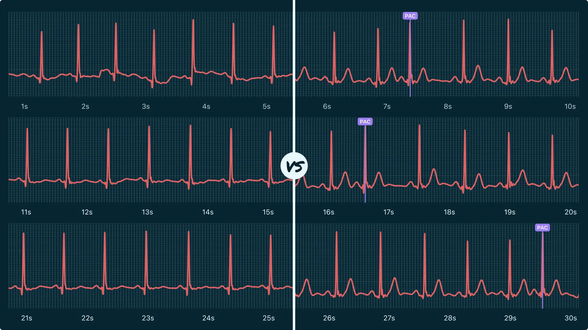 Sinus Rhythm Vs. Premature Atrial Contraction (Multiple) on Your Watch ...