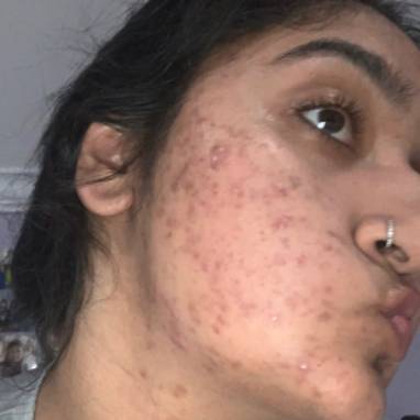 Image of our customer Rachel before using our product