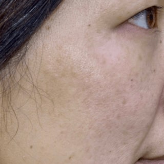 Image of our customer Rachel before using our product