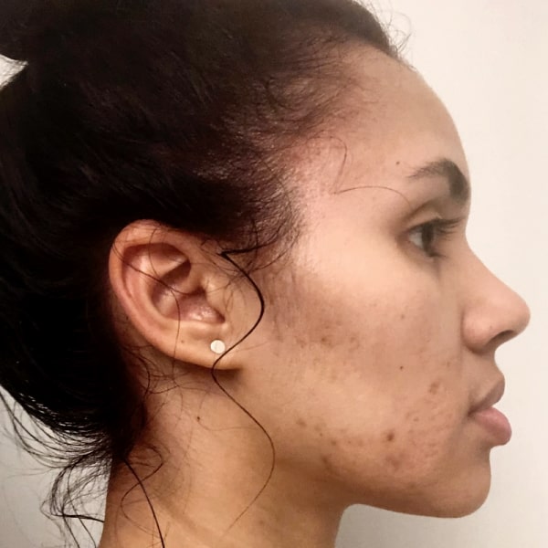 Image of our customer Rachel before using our product