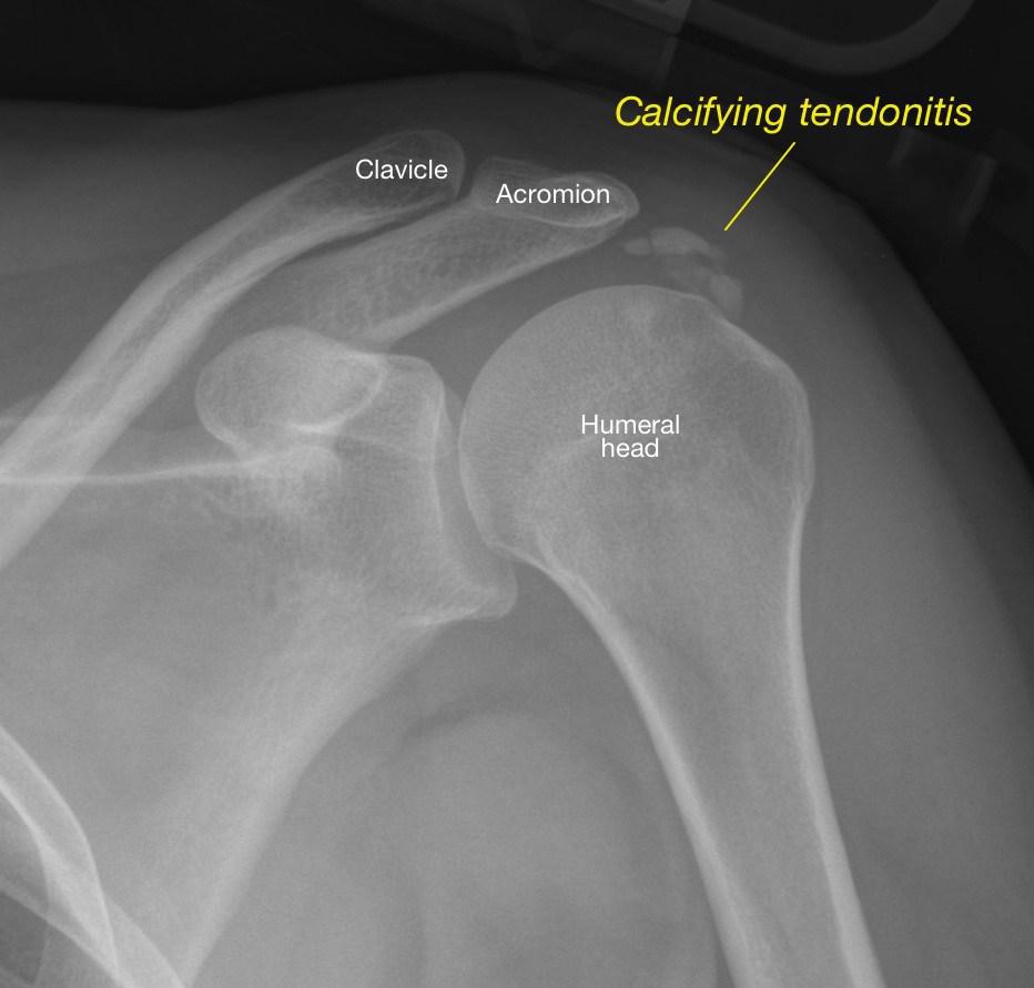 xray showing the presence of calcific tendintiis
