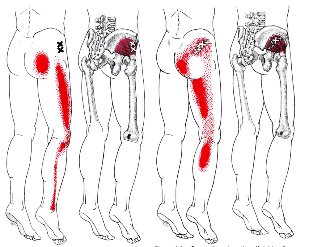 Diagram of hip and buttock pain patterns that spread down the leg.