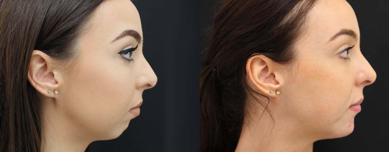 Forward Facial Growth How To Promote It In Adults