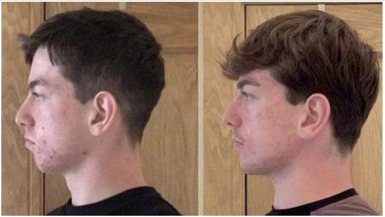 Dermaplaning Before & After Pictures: Does It Actually Work? - x9ofzbl