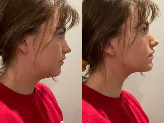 Are Double Chins Genetic Get Rid Of Genetic Double Chin Naturally 