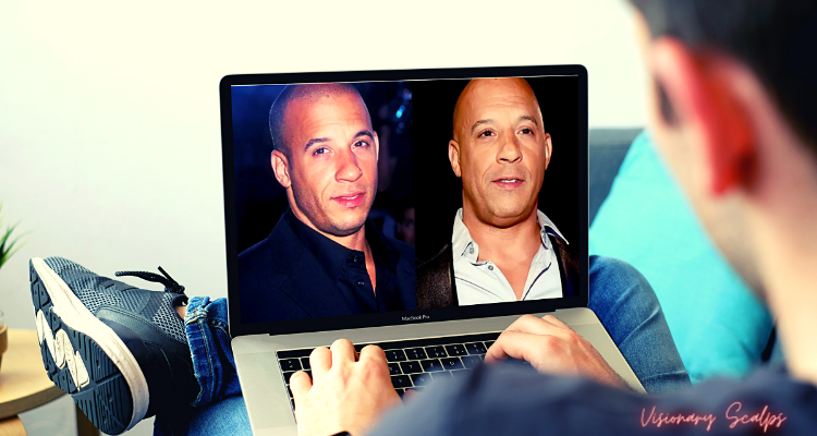 Celebrities with Scalp Micropigmentation
