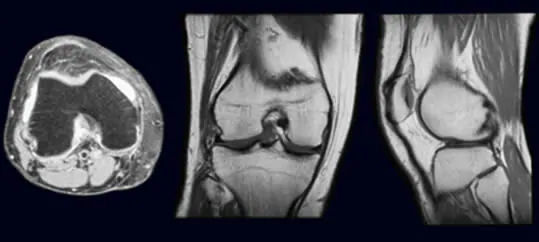 ginocchio menisco fisioterapia