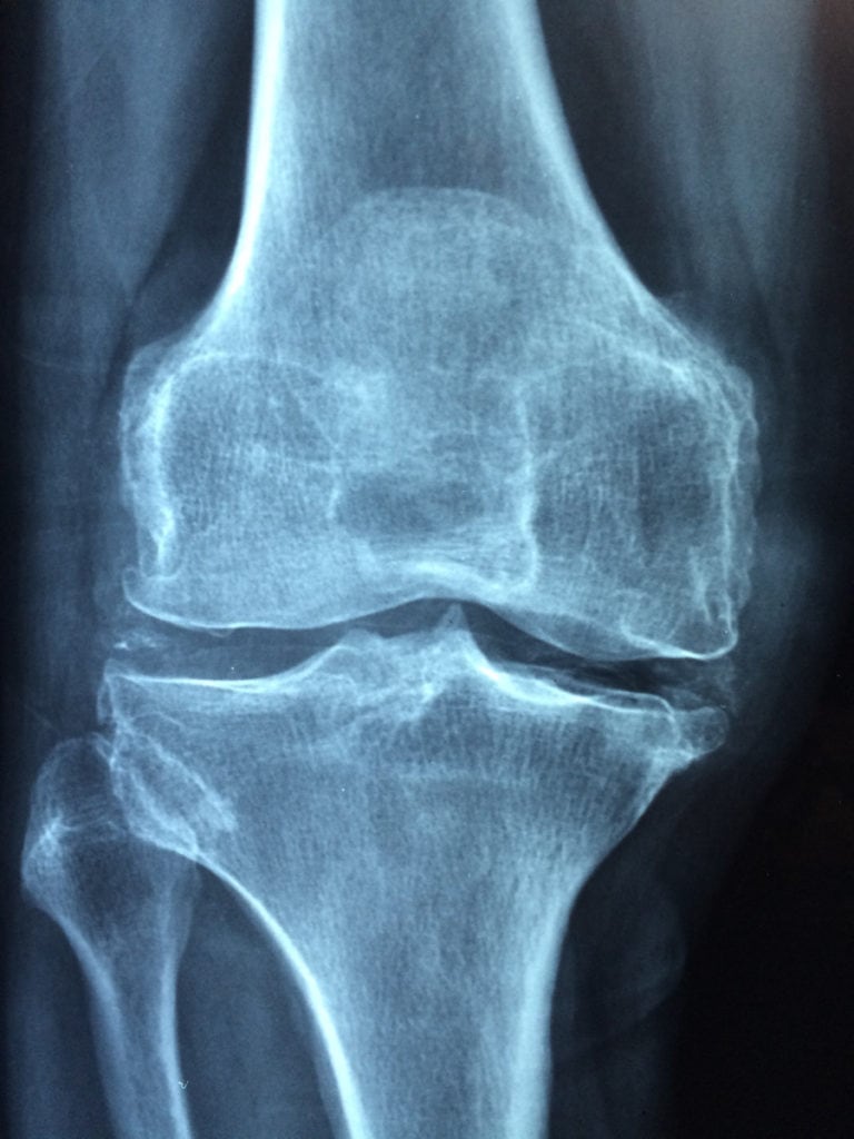 riabilitazione ginocchio radiografia