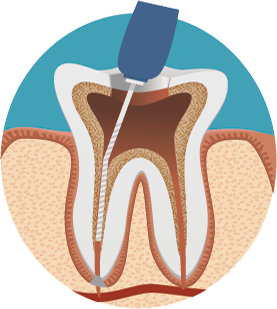 root canal treatment procedure