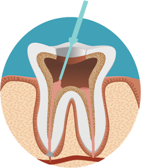 root canal treatment procedure