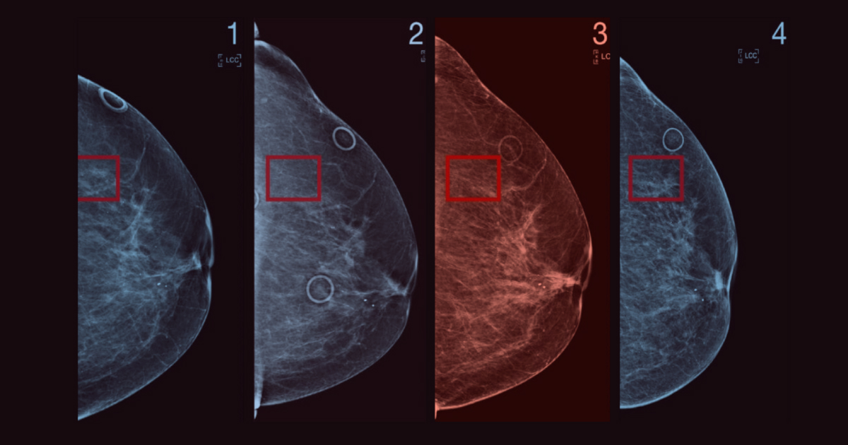 Jameel Clinic early breast cancer detection tool in KSA | Community Jameel