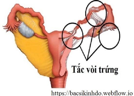 Tắc 2 vòi trứng có thai được không