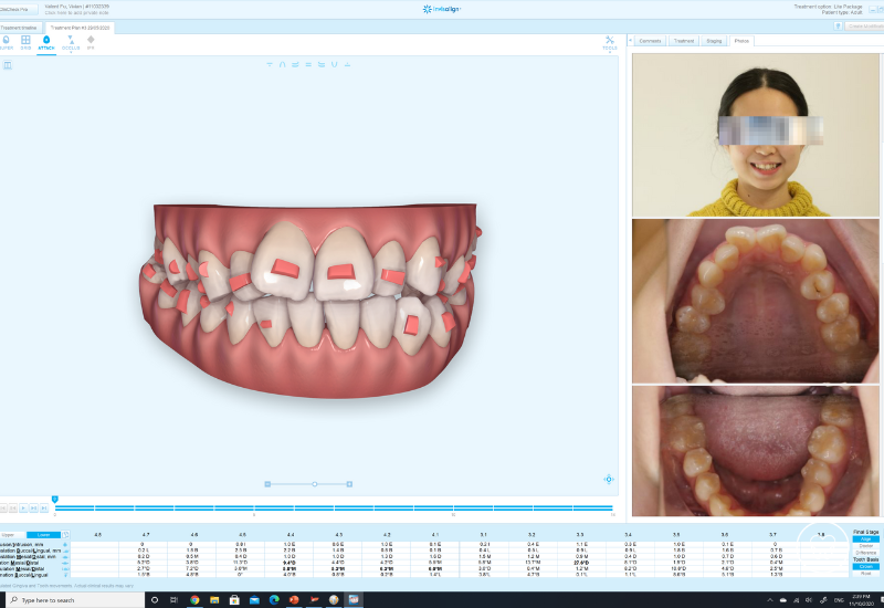 Invisalign vs. Smile Direct Club Are they really so different?