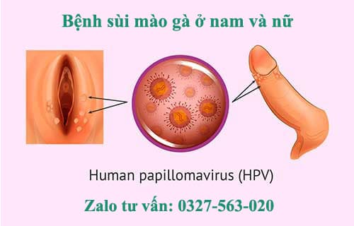 Bệnh sùi mào gà ở nam và nữ