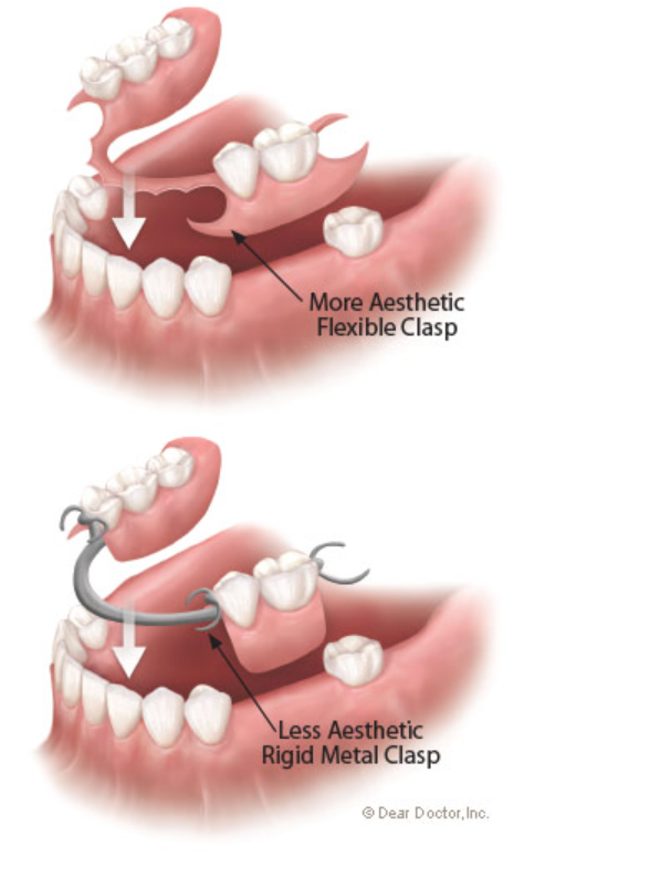 Flexible Partial Dentures Your Questions Answered
