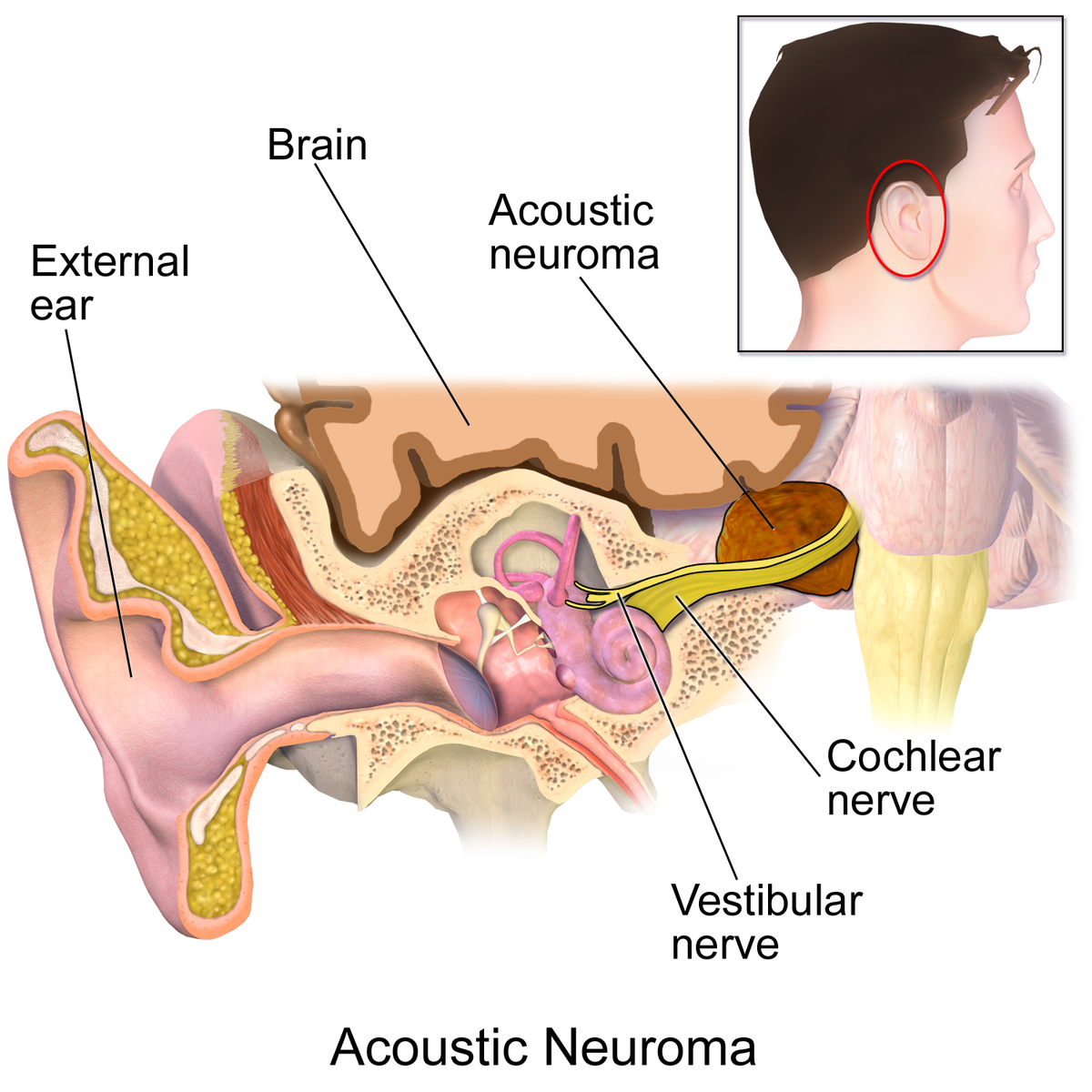 A diagram of an acoustic neuroma - a rarer cause of tinnitus