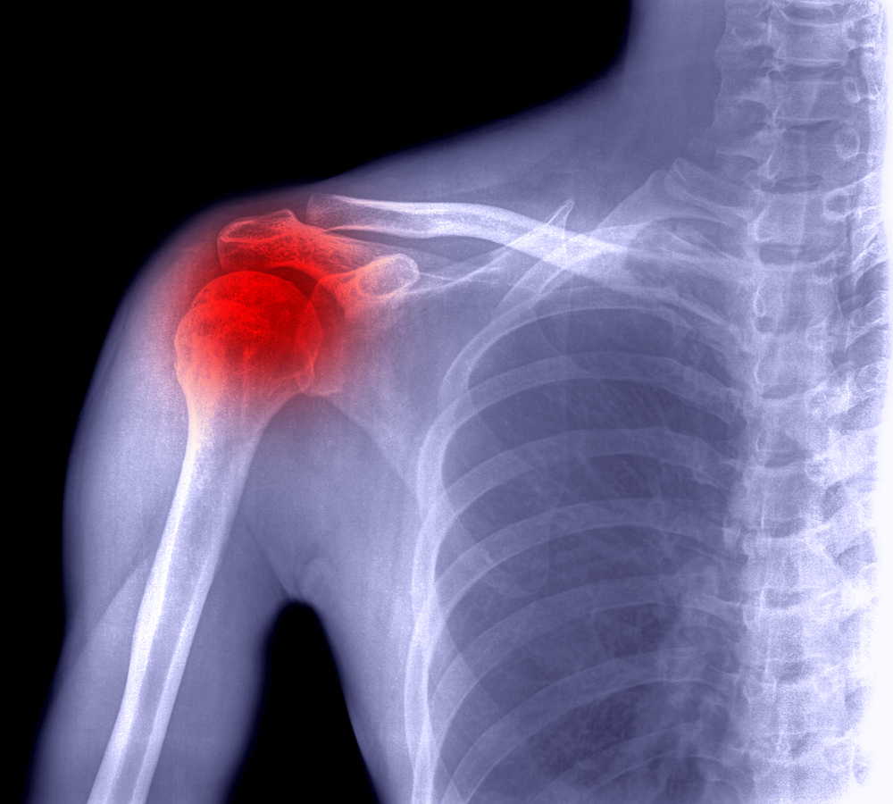 Frozen Shoulder & Diabetes Causes, Symptoms & Treatment Sugar.Fit