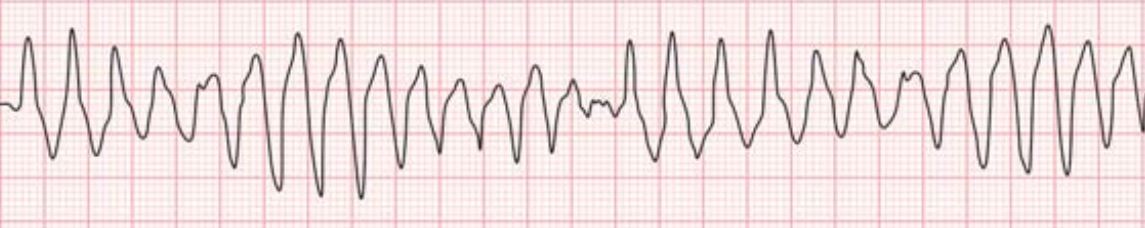 Long QT Syndrome (2)