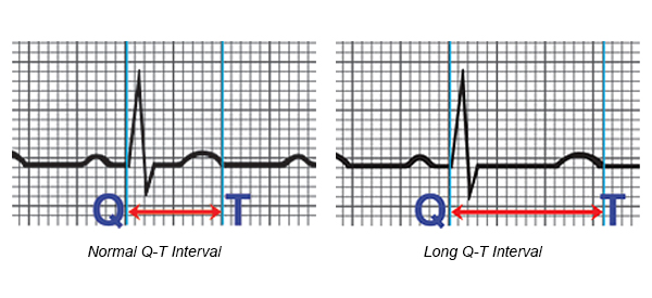 Long QT Syndrome (1)