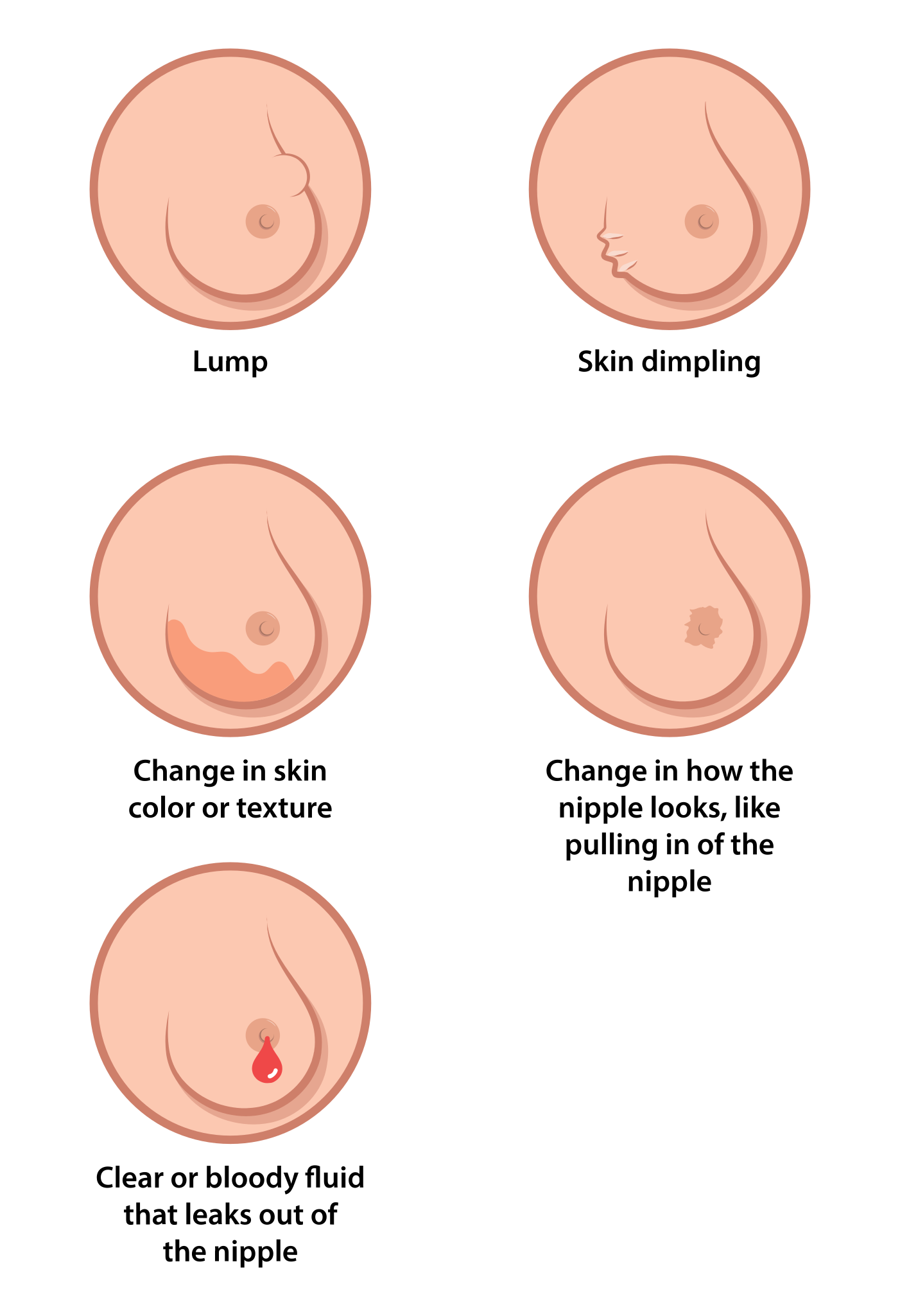 Breast Cancer