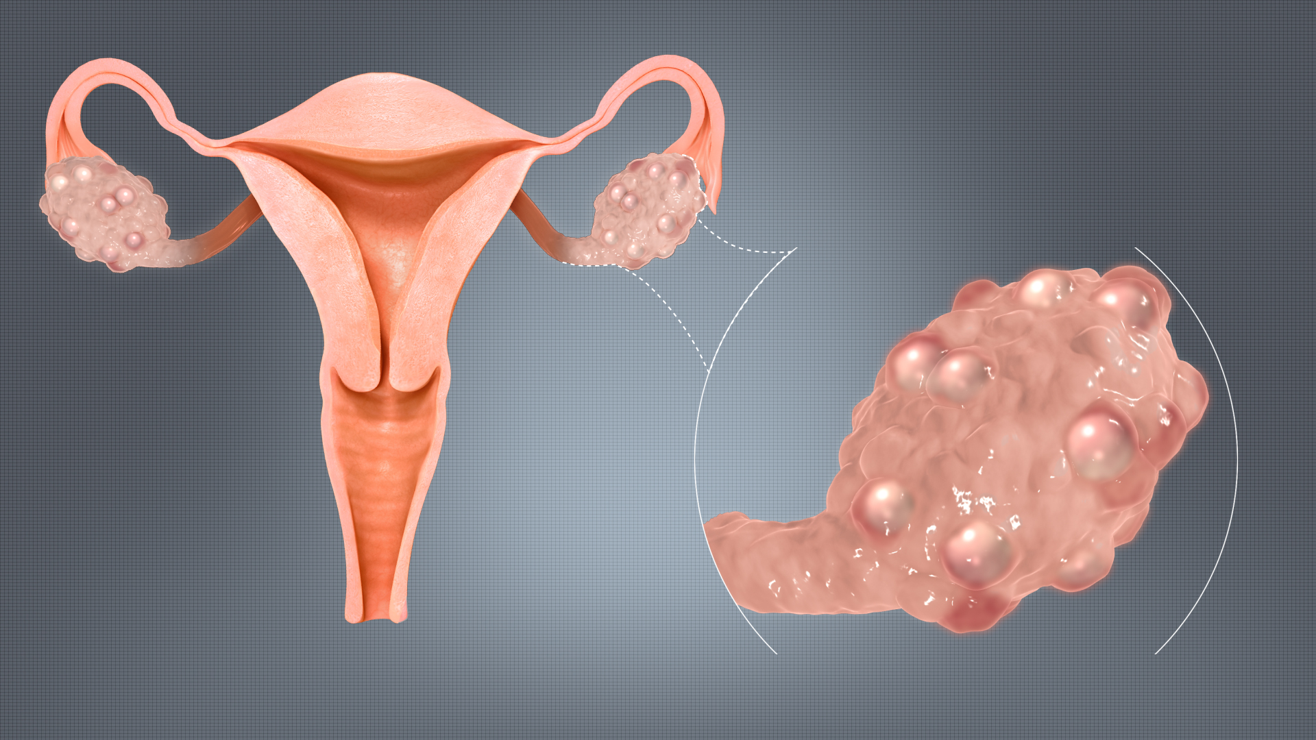 Polycystic Ovary Syndrome (1)