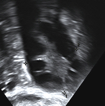 Polycystic Ovary Syndrome (2)