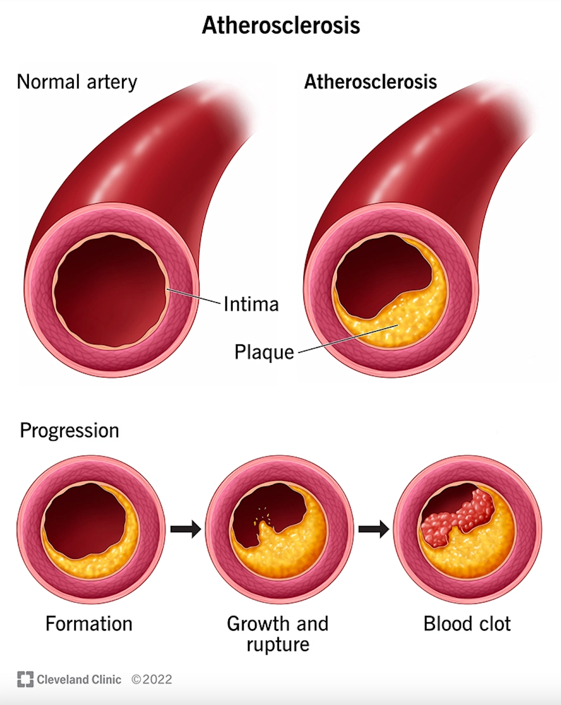 Coronary Artery Disease (1)