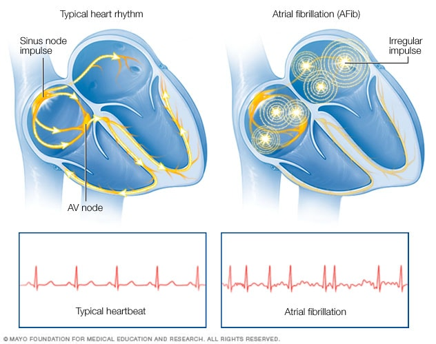 Atrial Fibrillation (2)