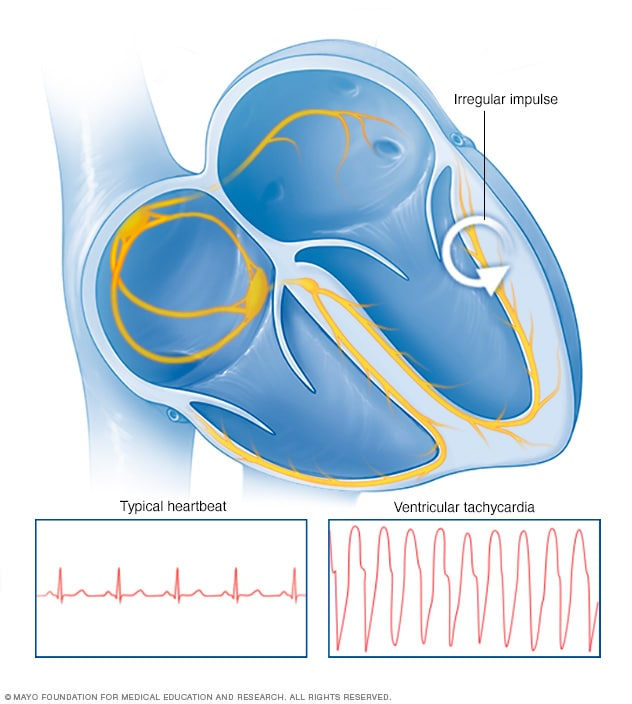 Brugada Syndrome (1)