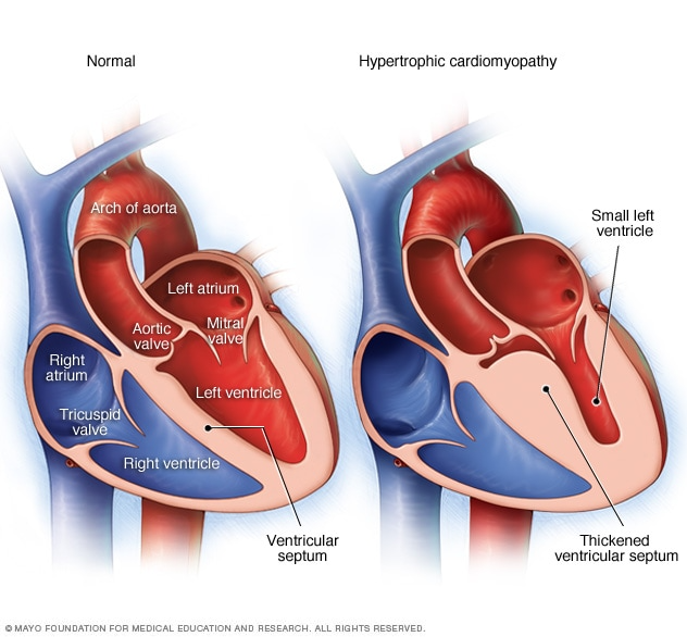 Hypertrophic Cardiomyopathy (1)
