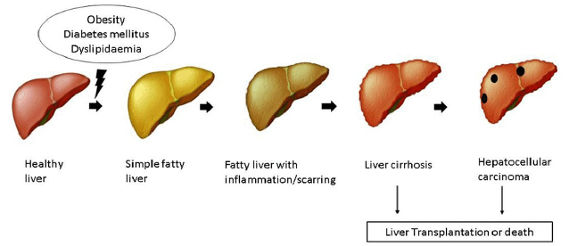 Non-Alcoholic Fatty Liver Disease