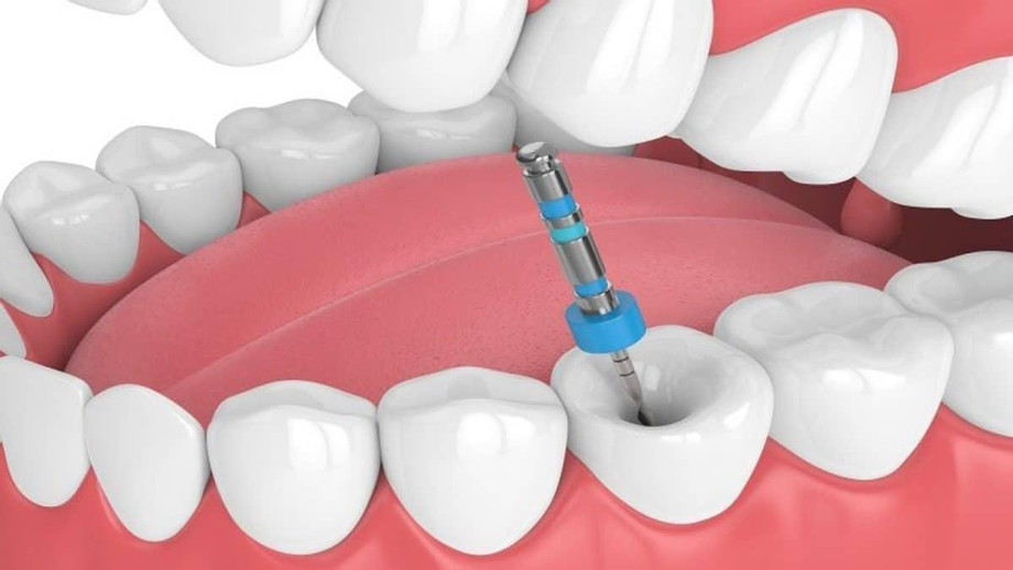 rootcanaltreatment1200x675.jpg