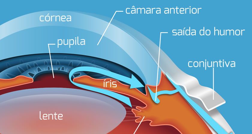 Glaucoma: ângulo Iridocorneano