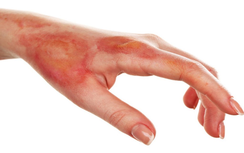 may dieu tri bang khi ap lanh chua lanh nhanh da bi bong 1024x640 - Công dụng tuyệt vời của máy điều trị khí áp lạnh có thể bạn chưa biết