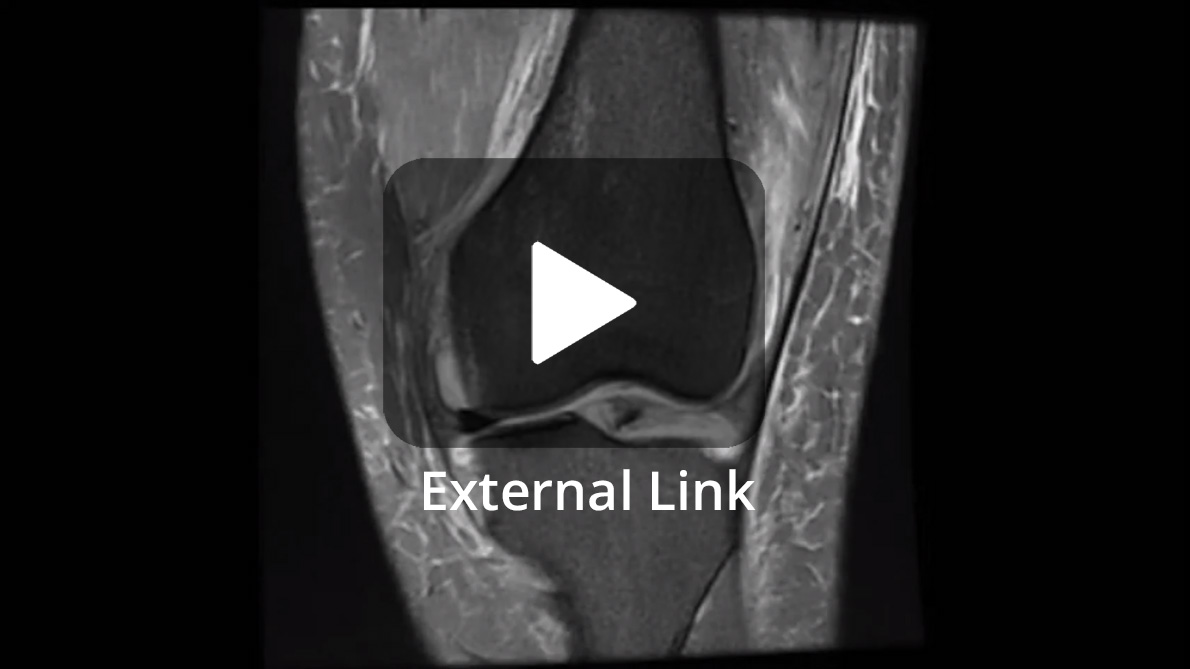 YouTube Video - Lateral Meniscus Transplant Teardrop Technique