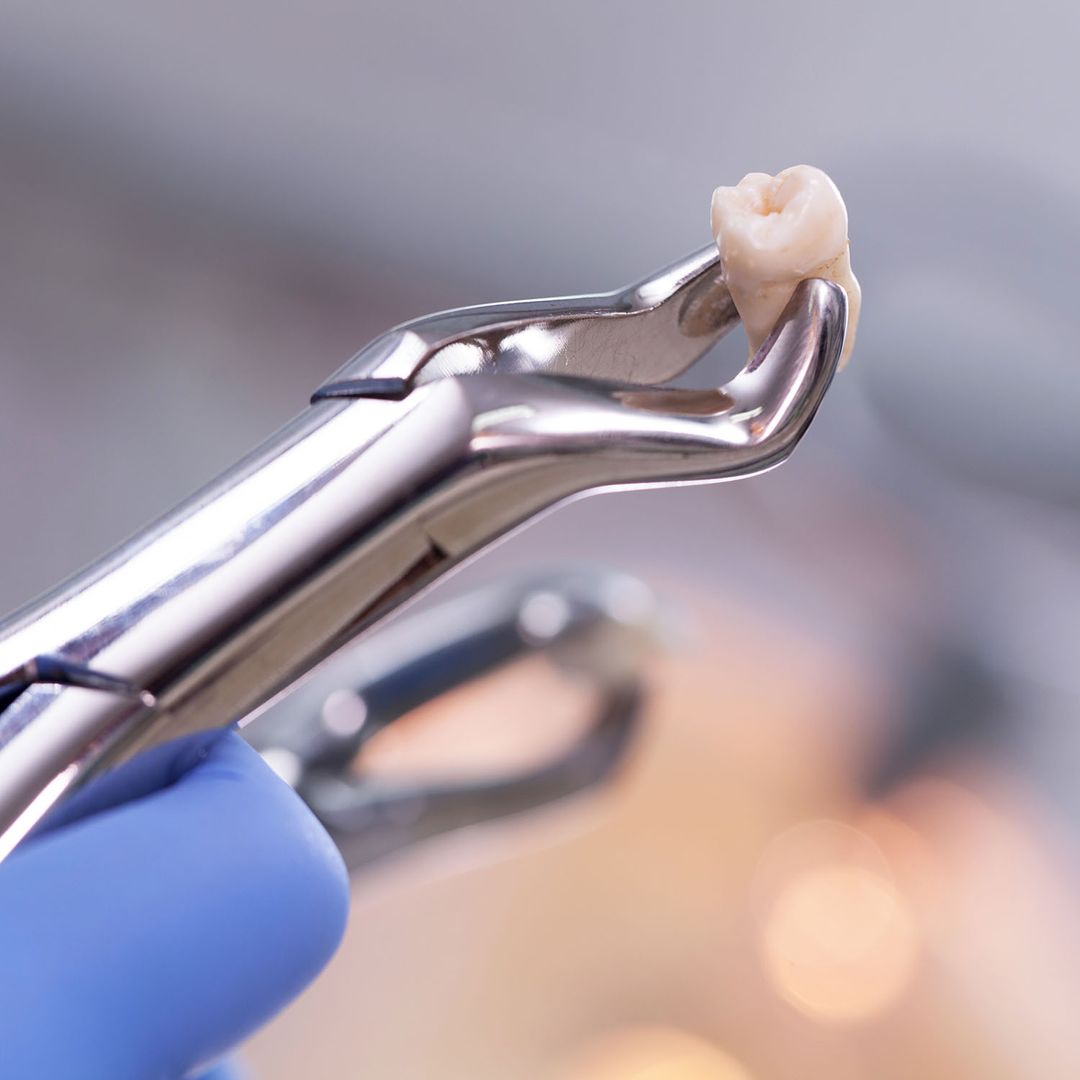 Post-Operative Instructions After Teeth Extractions