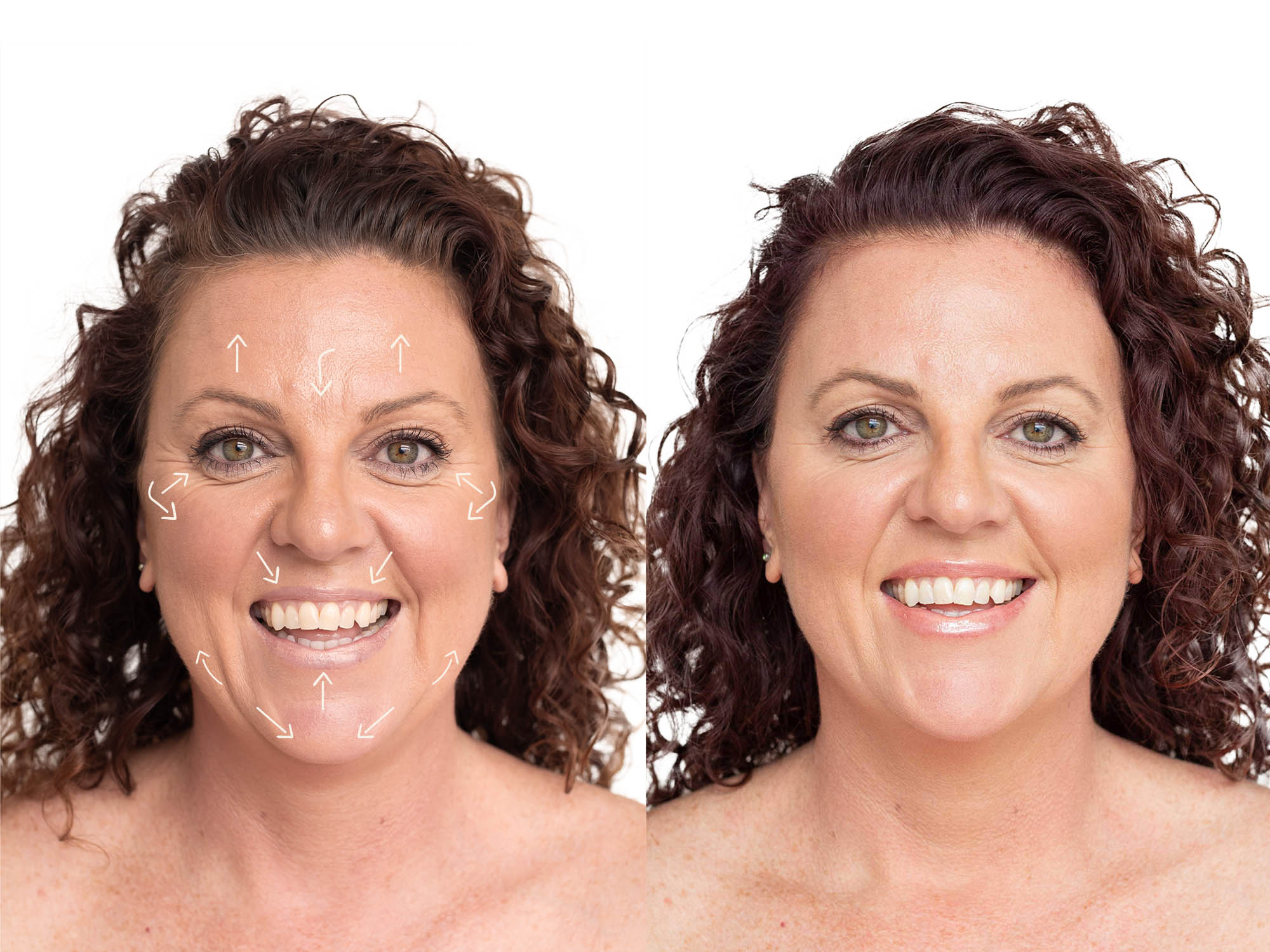 Anti-Wrinkle Injections | Kay + Co Cosmetic Rejuvenation