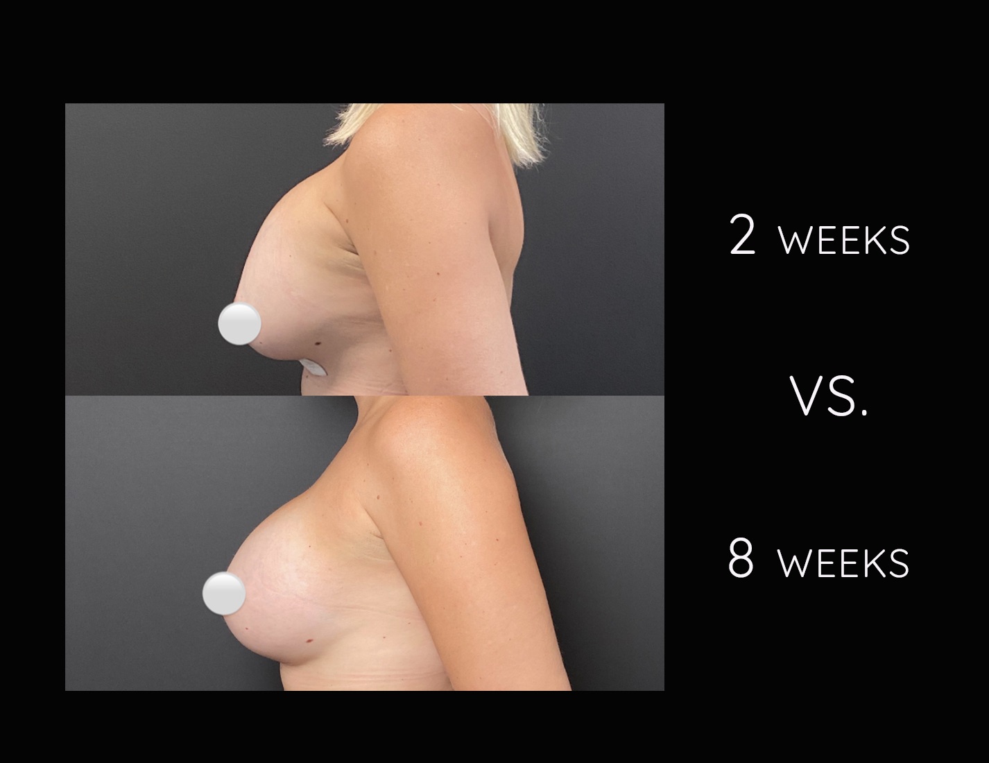 Breast augmentation after photos 2 weeks post-op vs. 8 weeks post-op