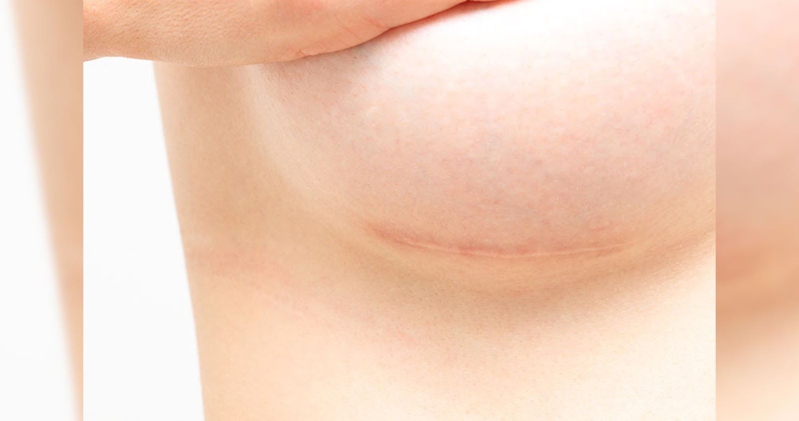 breast augmentation crease incision and scar