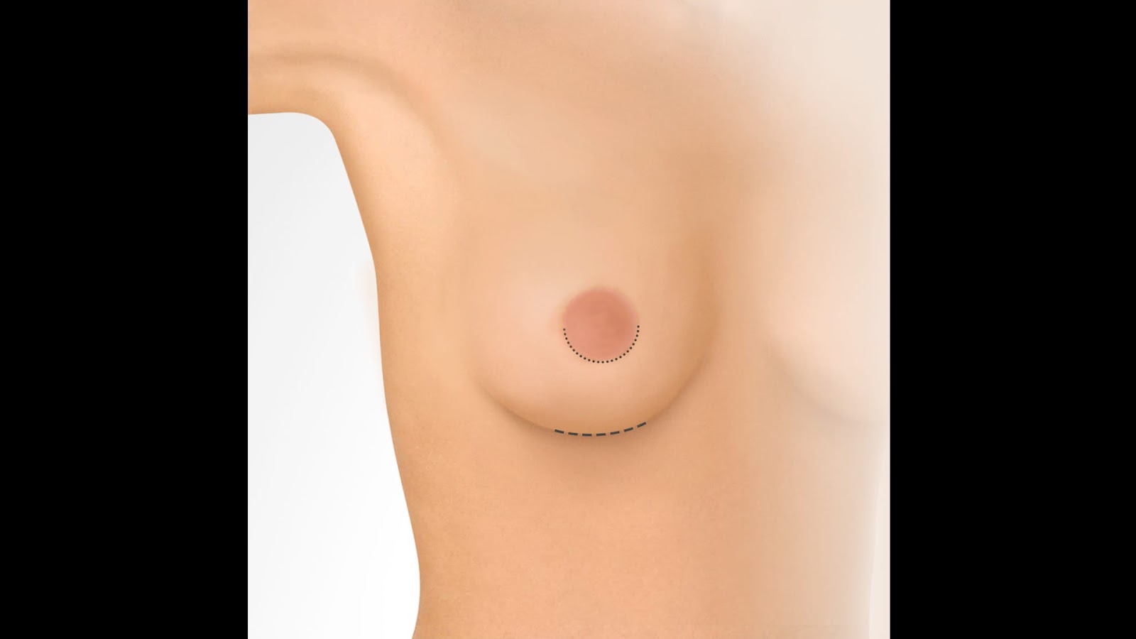 Periareolar and crease/inframammary breast augmentation incisions