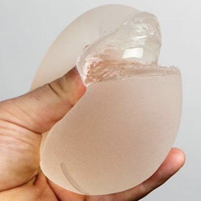 Ruptured fifth-generation silicone gummy bear breast implant
