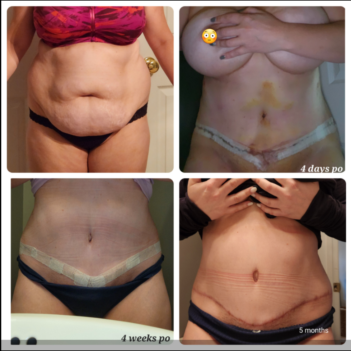 tummy tuck recovery before and after progress photos