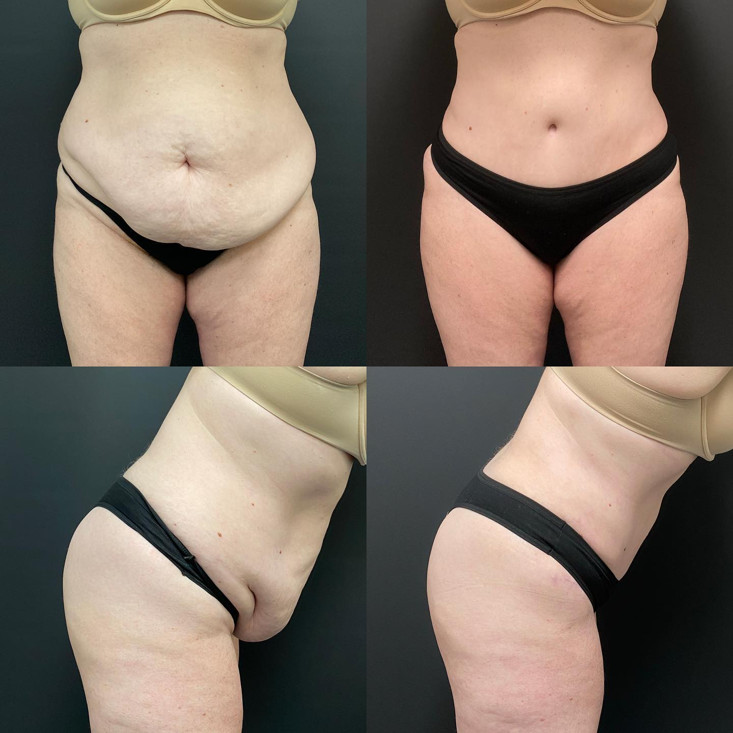 modern tummy tuck before and after photo